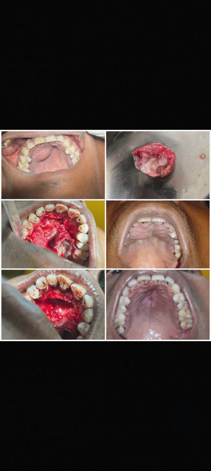 palatal cyst enucleation